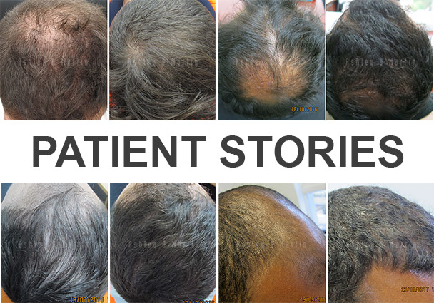 Case Study: In-Home Laser Therapy and RealGROWTH Regrows Hair without Clinic  Visits | Ashley and Martin Melbourne